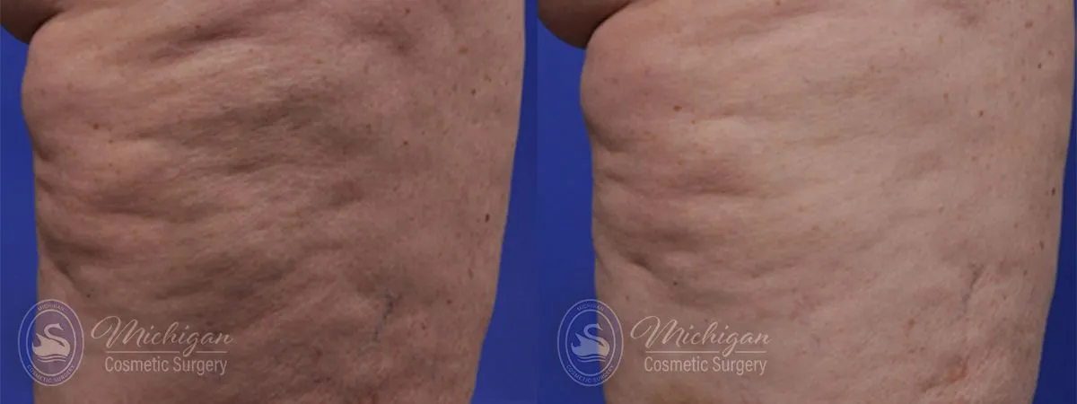 cellulite before after image