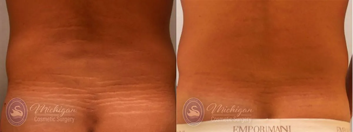 stretch mark before and after image