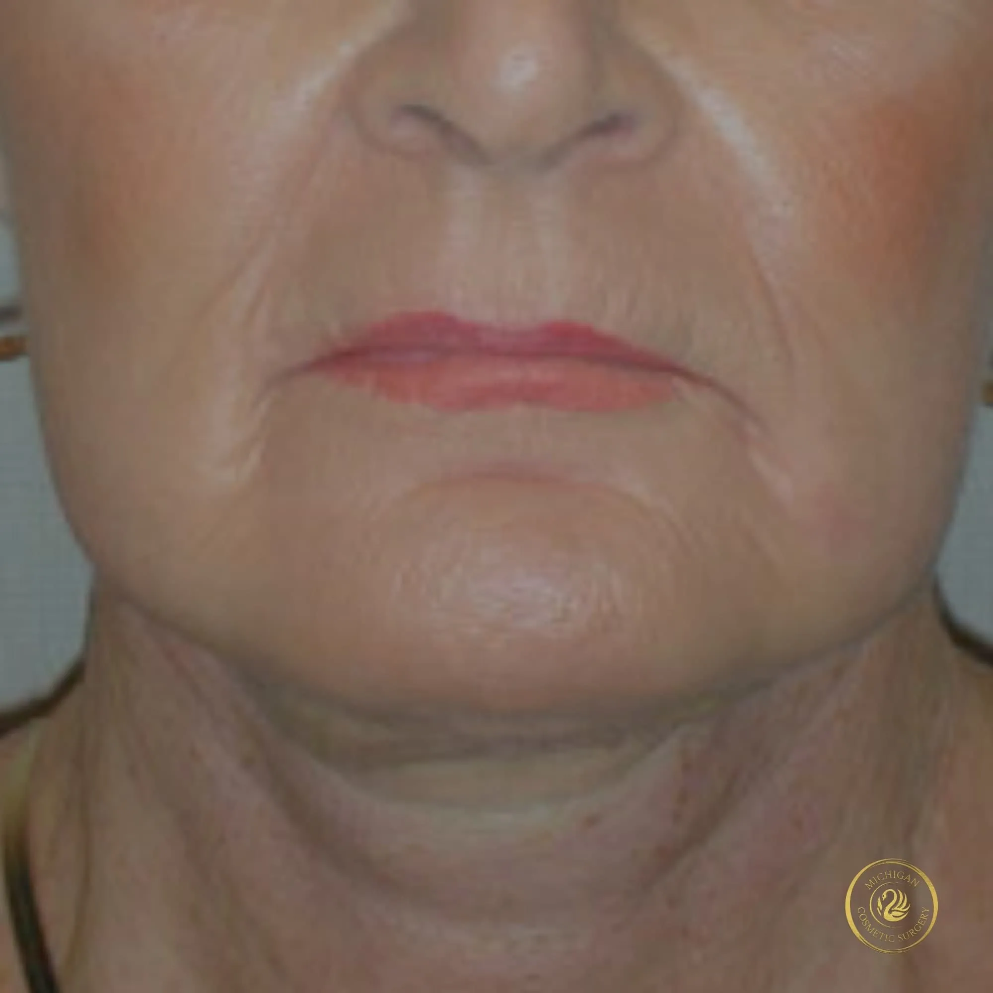 facelift after photo by michigan cosmetic surgery in southfield mi