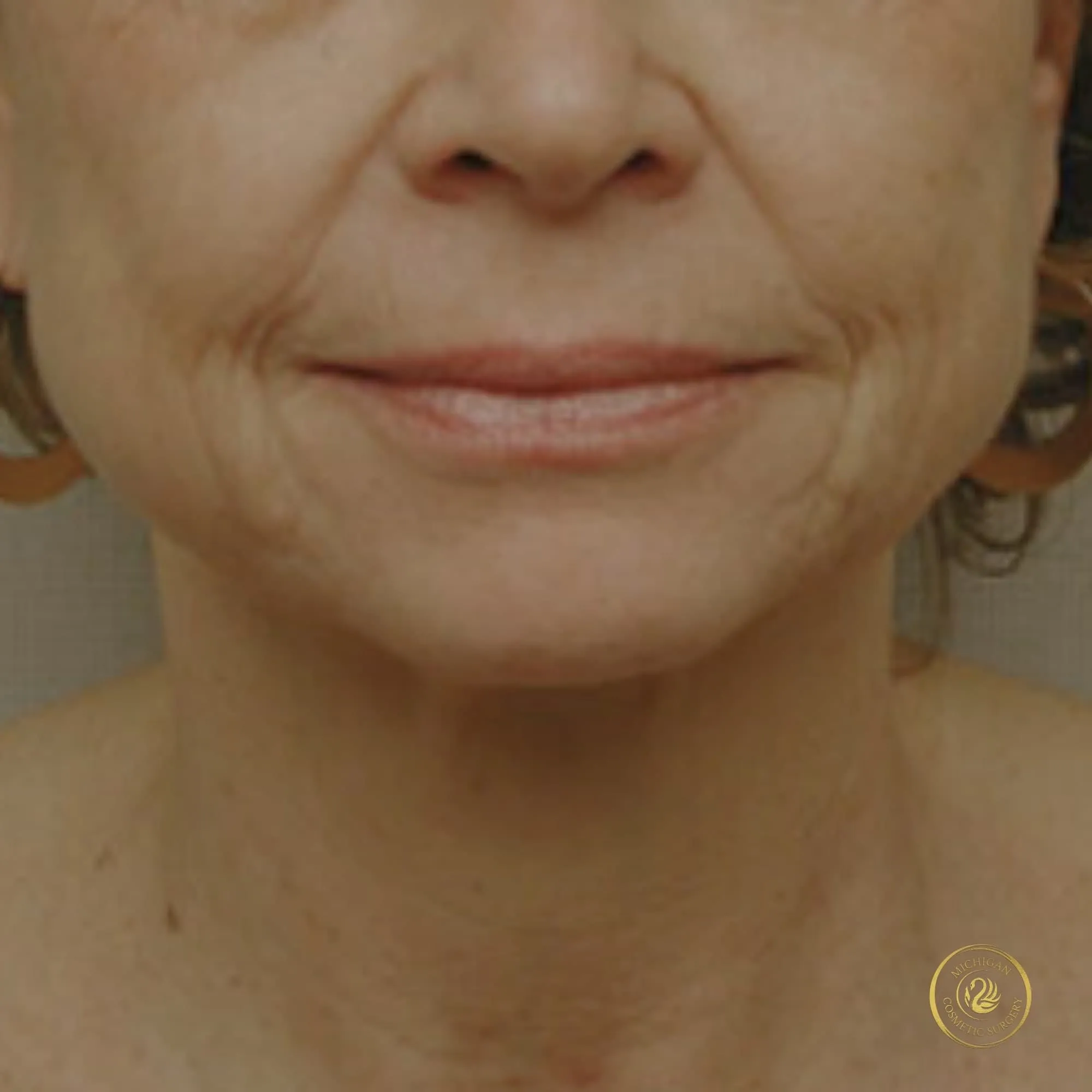facelift before photo by michigan cosmetic surgery in southfield mi