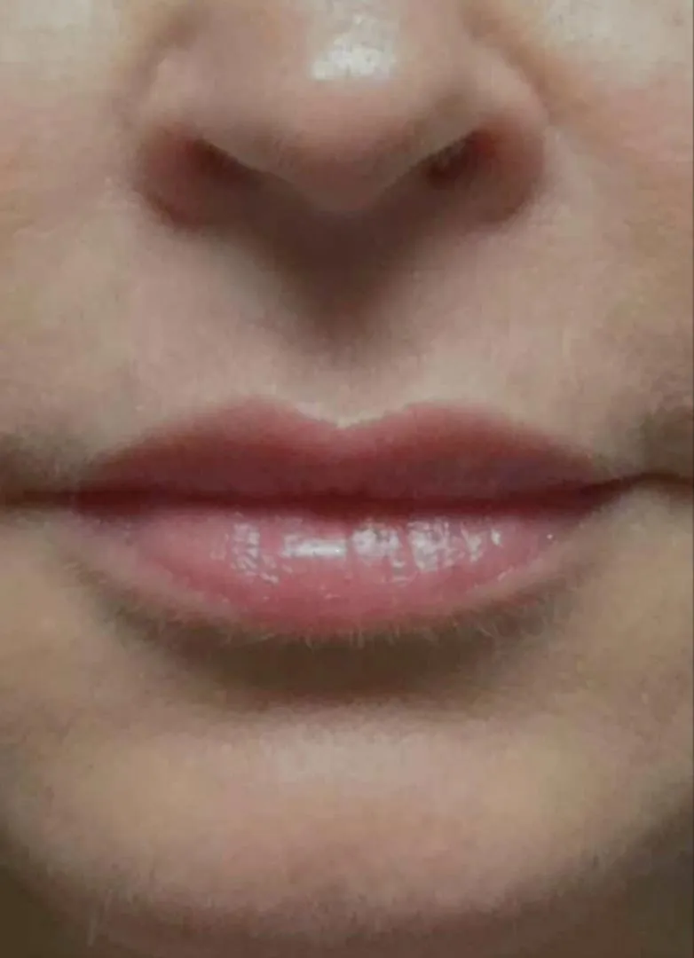 filler before photo by michigan cosmetic surgery in southfield mi