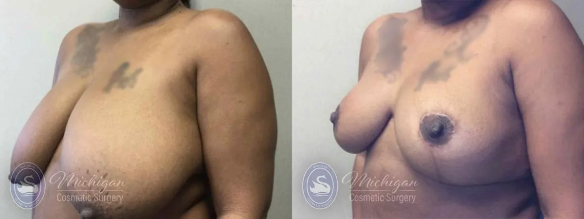 Breast Reduction Michigan