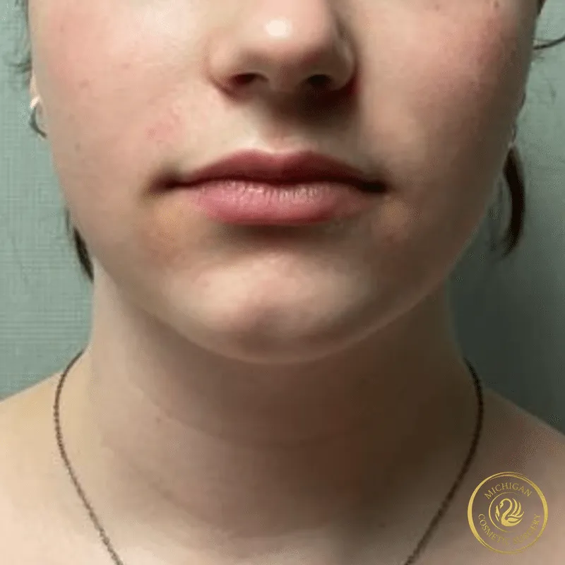 chin liposuction after photo by michigan cosmetic surgery in southfield mi