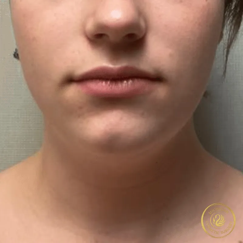 chin liposuction before photo by michigan cosmetic surgery in southfield mi