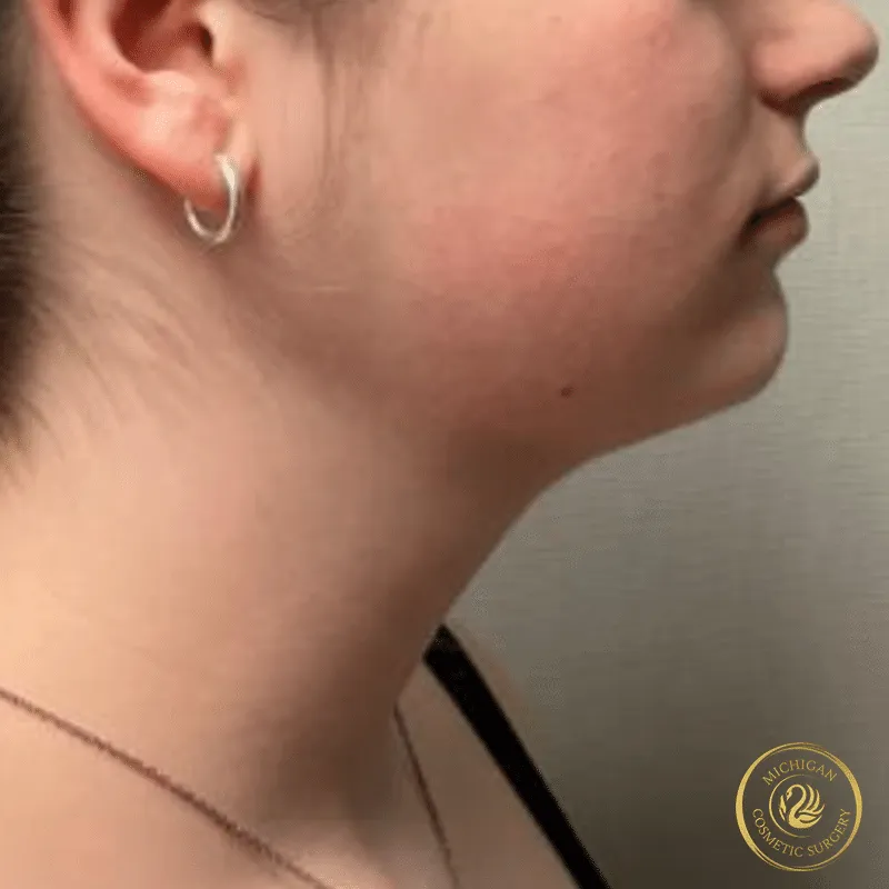 chin liposuction after photo by michigan cosmetic surgery in southfield mi