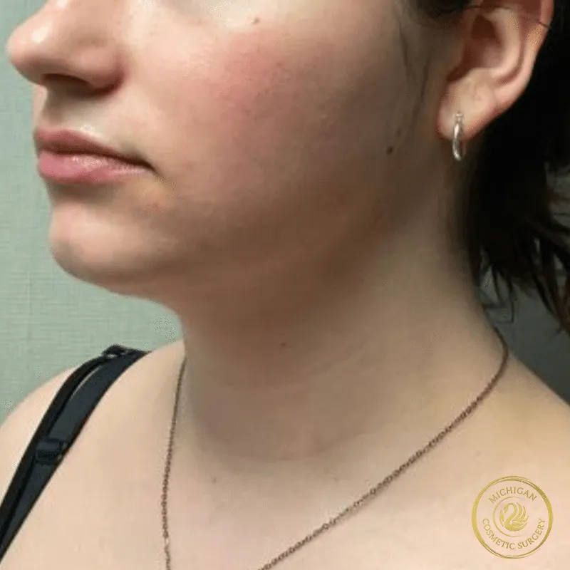 chin liposuction after photo by michigan cosmetic surgery in southfield mi