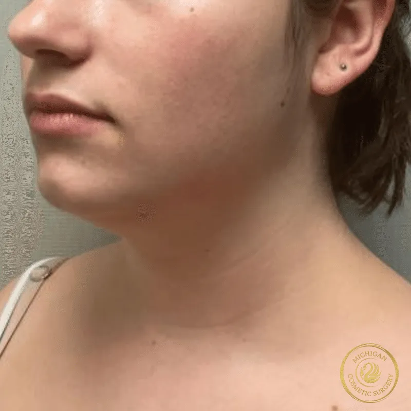 chin liposuction before photo by michigan cosmetic surgery in southfield mi