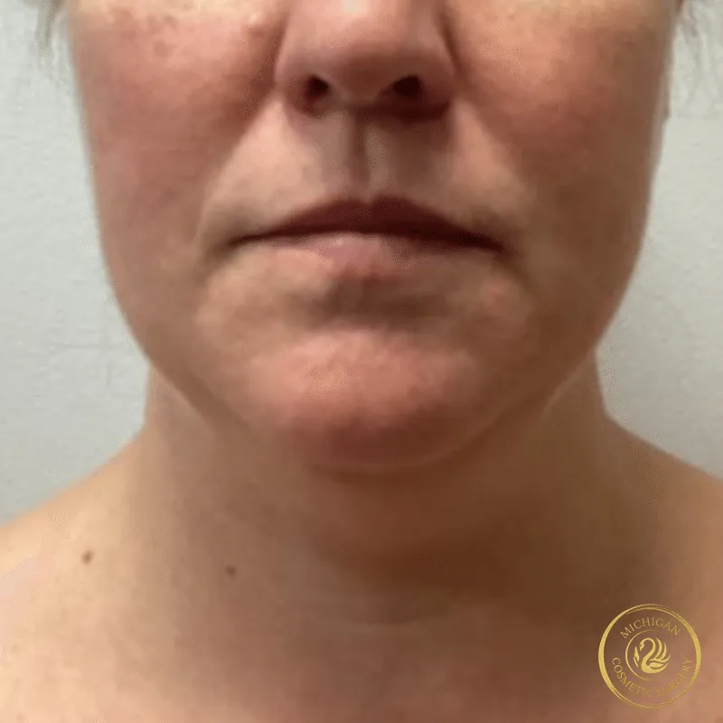 chin liposuction before photo by michigan cosmetic surgery in southfield mi