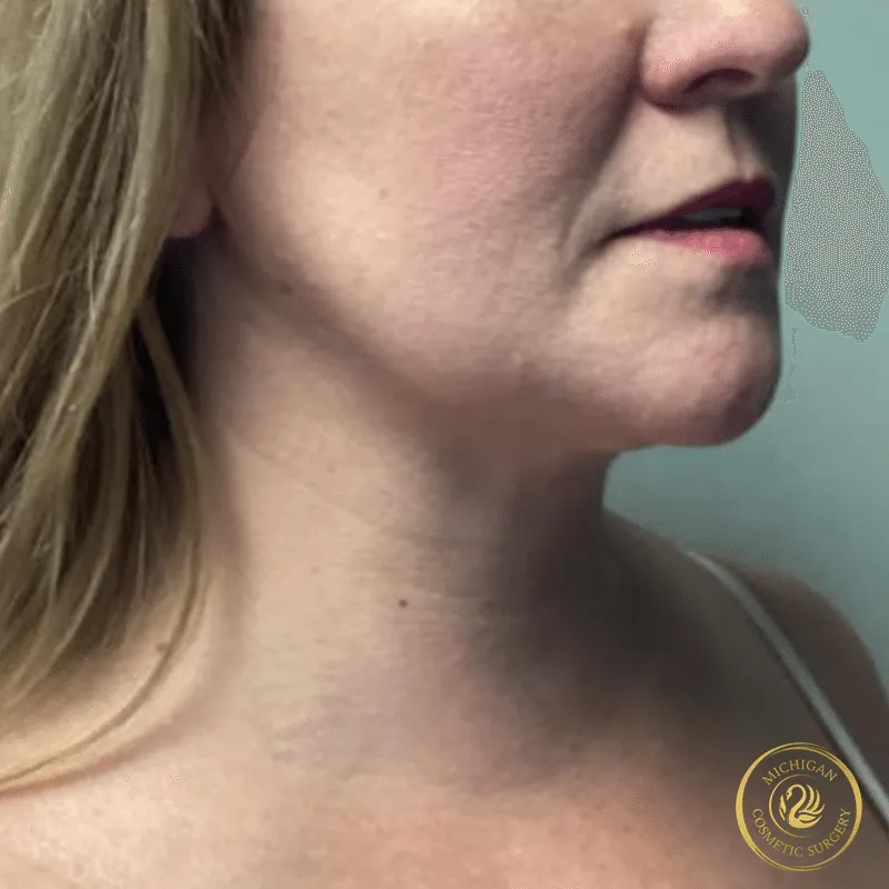 chin liposuction after photo by michigan cosmetic surgery in southfield mi