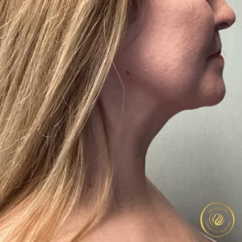 chin liposuction after photo by michigan cosmetic surgery in southfield mi