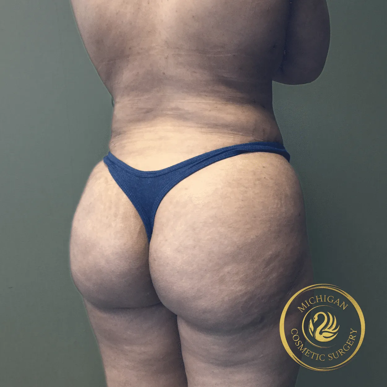 liposuction after photo by michigan cosmetic surgery in southfield mi