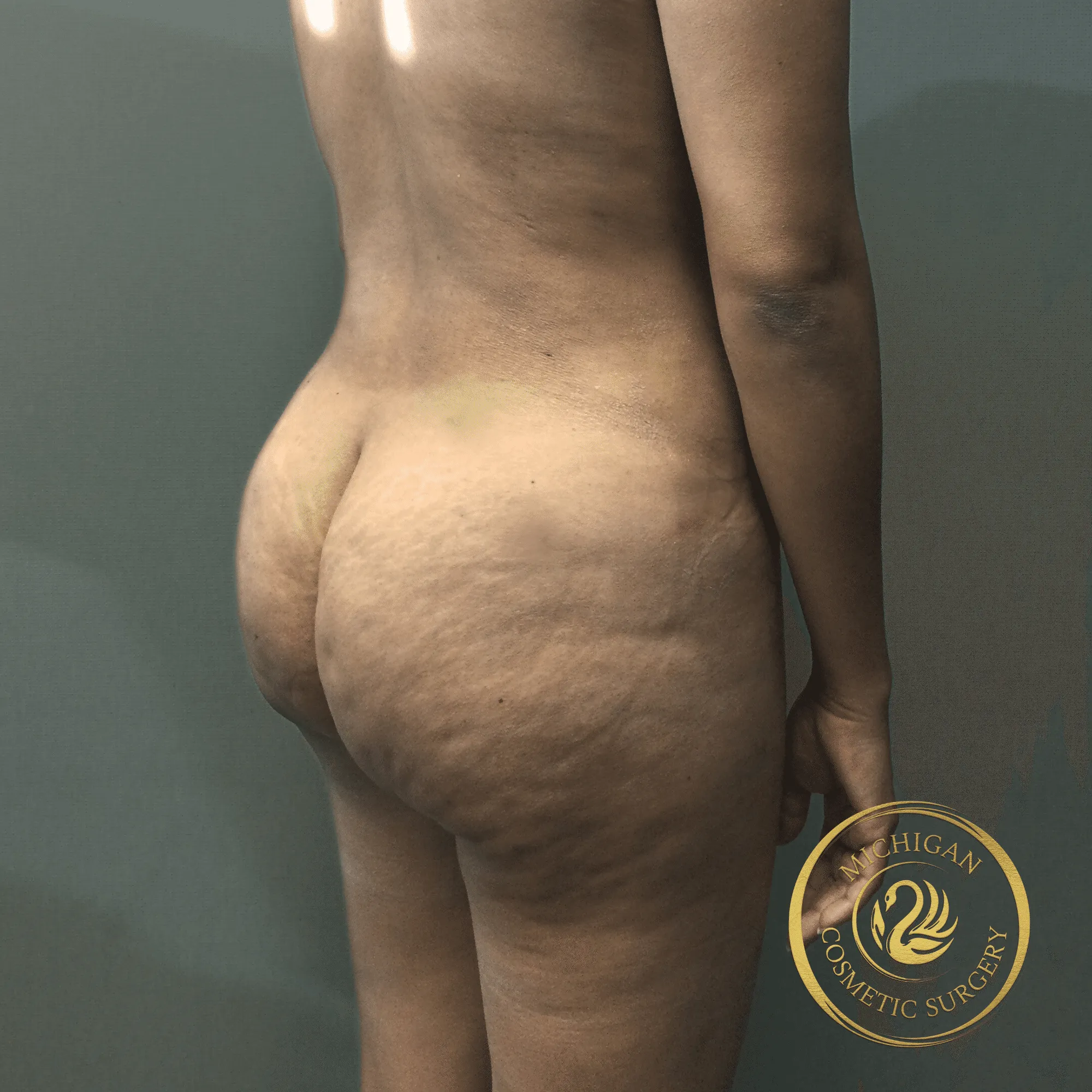 brazilian butt lift after photo by michigan cosmetic surgery in southfield mi