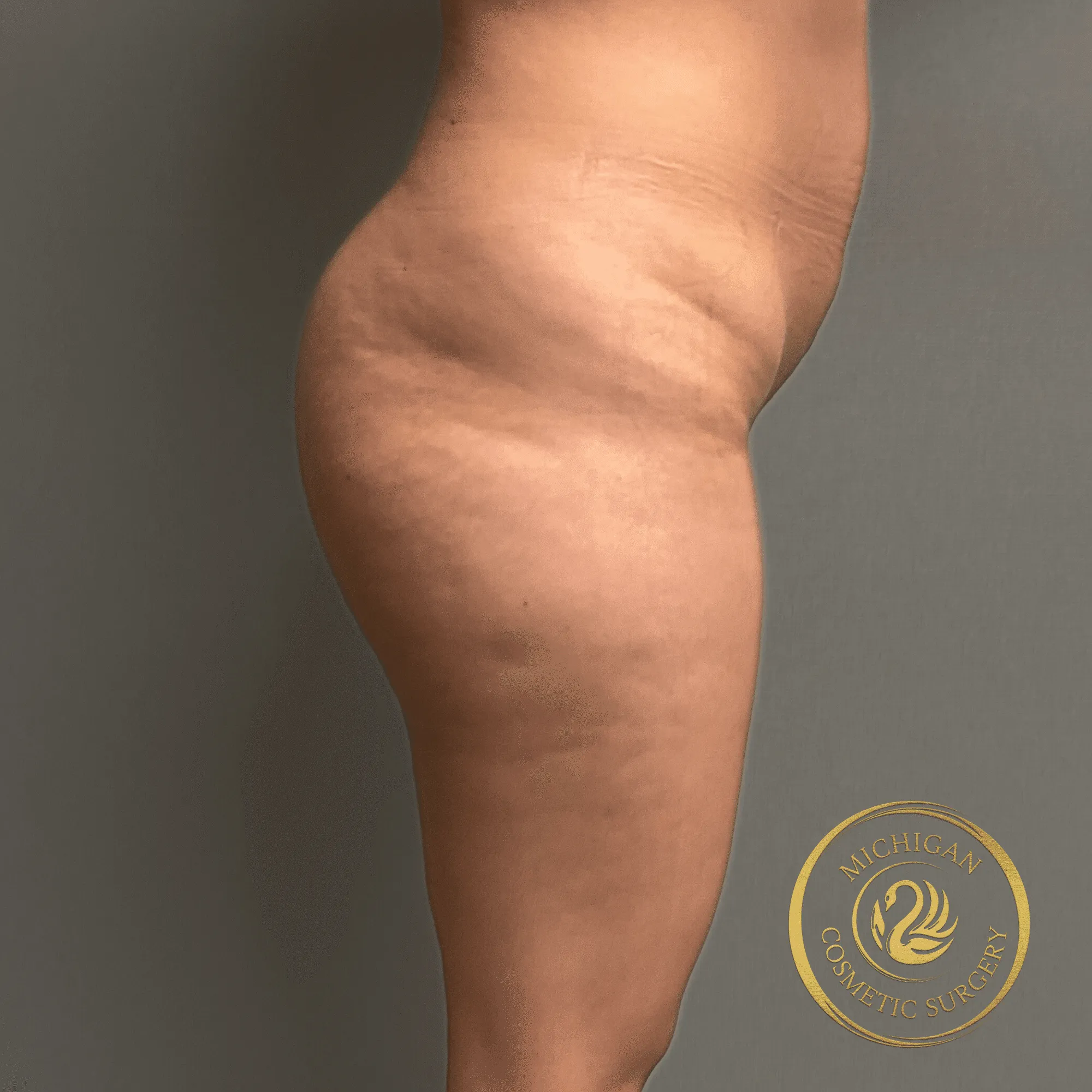 brazilian butt lift before photo by michigan cosmetic surgery in southfield mi