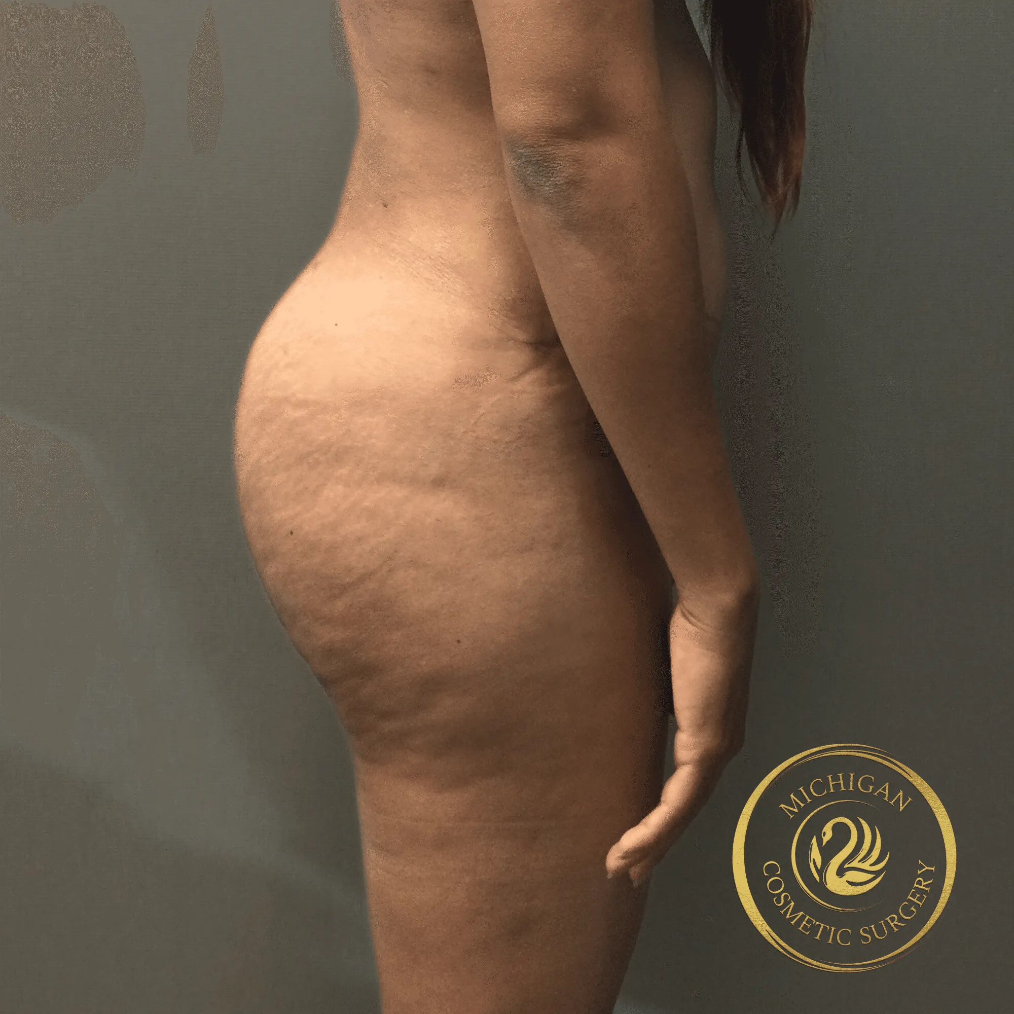 brazilian butt lift after photo by michigan cosmetic surgery in southfield mi