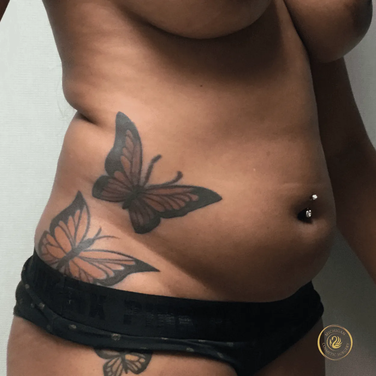 liposuction before photo by michigan cosmetic surgery in southfield mi