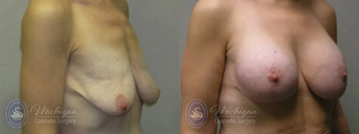 Michigan Cosmetic Surgery Southfield Breast Augmentation Medium Lift P