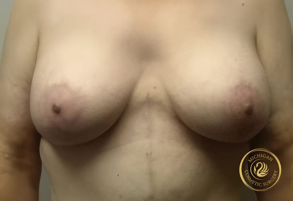breast augmentation and lift after photo by michigan cosmetic surgery in southfield mi