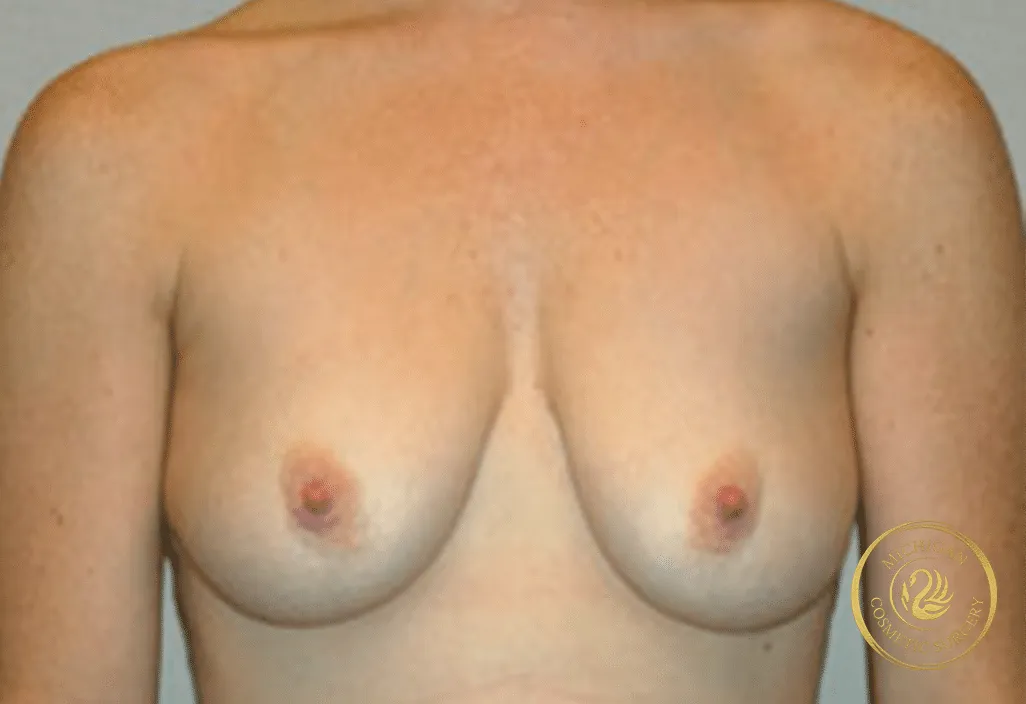 breast augmentation and lift before photo by michigan cosmetic surgery in southfield mi
