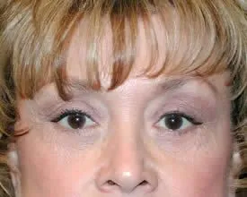 blepharoplasty after photo by michigan cosmetic surgery in southfield mi