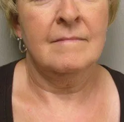 facelift before photo by michigan cosmetic surgery in southfield mi
