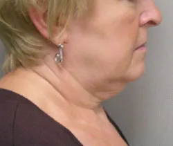 facelift before photo by michigan cosmetic surgery in southfield mi