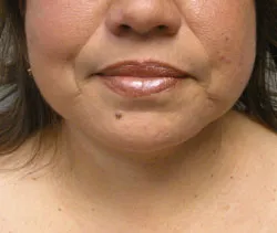 facelift after photo by michigan cosmetic surgery in southfield mi