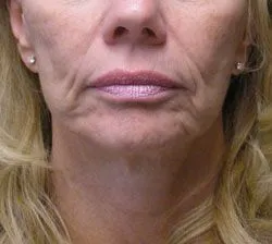 facelift before photo by michigan cosmetic surgery in southfield mi