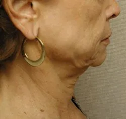 facelift before photo by michigan cosmetic surgery in southfield mi