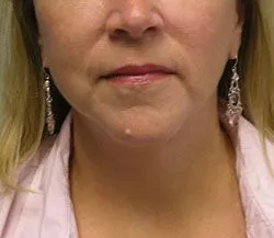 facelift after photo by michigan cosmetic surgery in southfield mi
