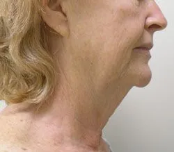 facelift before photo by michigan cosmetic surgery in southfield mi