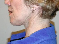 facelift after photo by michigan cosmetic surgery in southfield mi