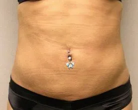 liposuction after photo by michigan cosmetic surgery in southfield mi