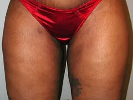 liposuction after photo by michigan cosmetic surgery in southfield mi