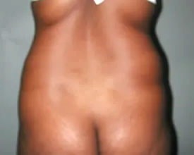 liposuction before photo by michigan cosmetic surgery in southfield mi