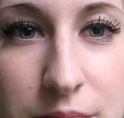 rhinoplasty before photo by michigan cosmetic surgery in southfield mi