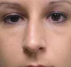 rhinoplasty before photo by michigan cosmetic surgery in southfield mi