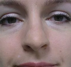 rhinoplasty before photo by michigan cosmetic surgery in southfield mi