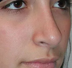 rhinoplasty after photo by michigan cosmetic surgery in southfield mi