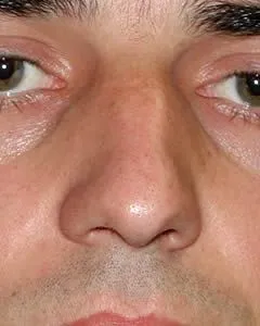 rhinoplasty before photo by michigan cosmetic surgery in southfield mi