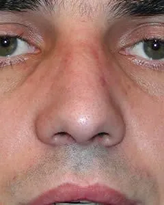 rhinoplasty after photo by michigan cosmetic surgery in southfield mi