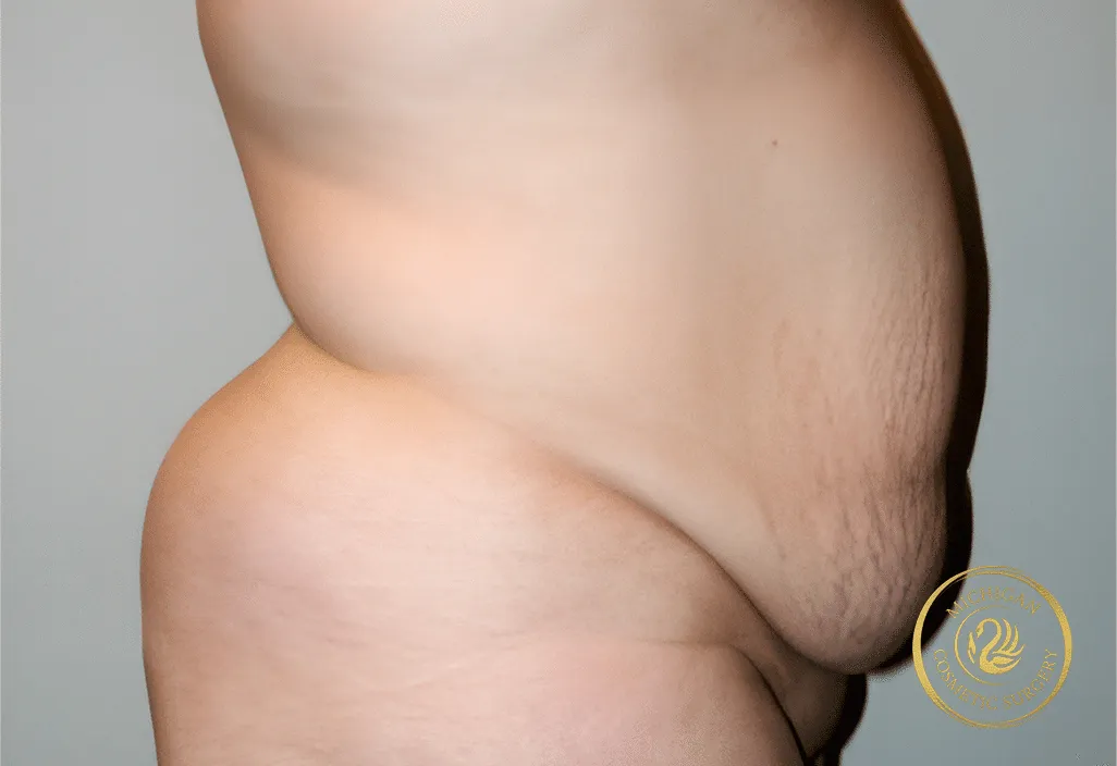 tummy tuck before photo by michigan cosmetic surgery in southfield mi
