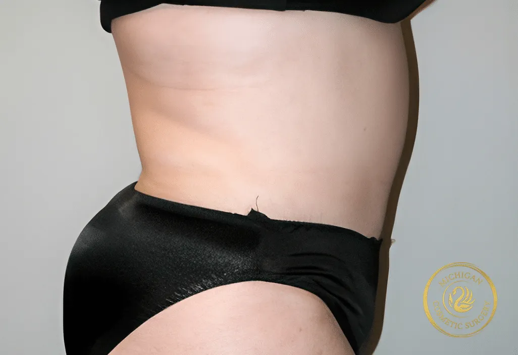 tummy tuck before photo by michigan cosmetic surgery in southfield mi