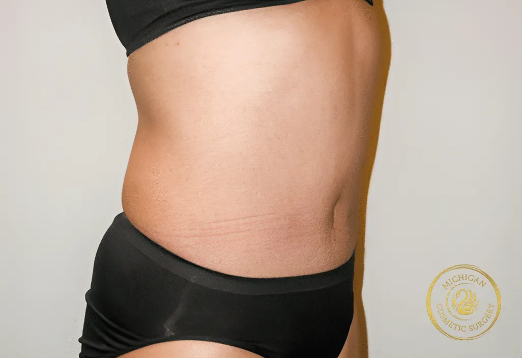 tummy tuck after photo by michigan cosmetic surgery in southfield mi