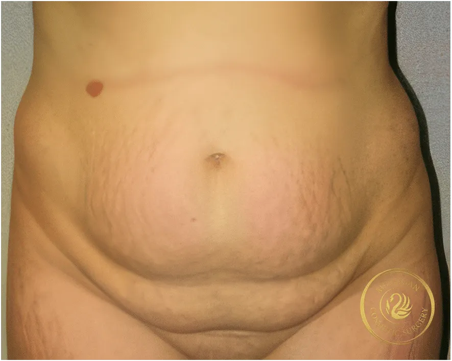 tummy tuck before photo by michigan cosmetic surgery in southfield mi