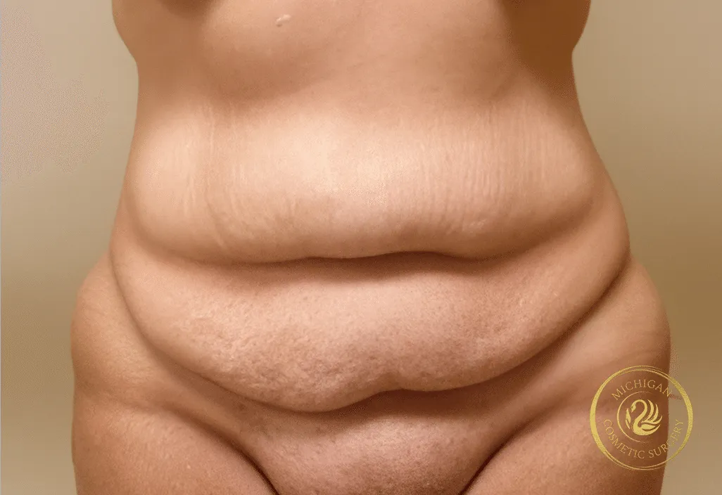 tummy tuck before photo by michigan cosmetic surgery in southfield mi