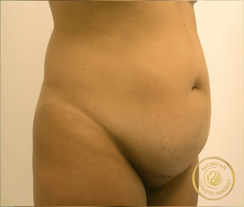 tummy tuck before photo by michigan cosmetic surgery in southfield mi