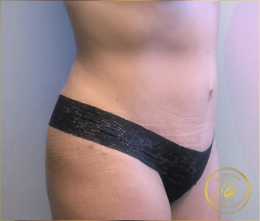 tummy tuck after photo by michigan cosmetic surgery in southfield mi