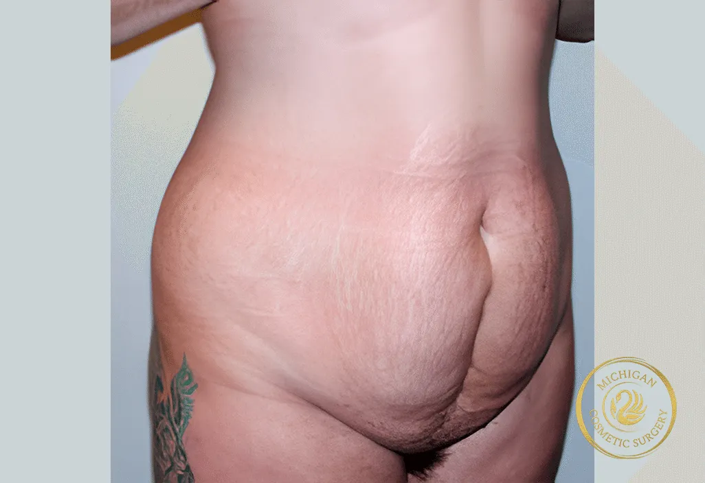 tummy tuck before photo by michigan cosmetic surgery in southfield mi