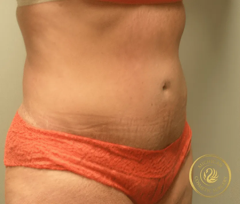 tummy tuck before photo by michigan cosmetic surgery in southfield mi