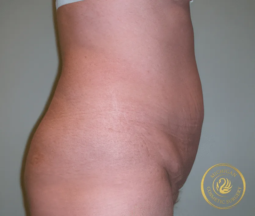 tummy tuck before photo by michigan cosmetic surgery in southfield mi